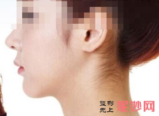 武汉吴中兴截骨怎么样？截骨手术前后效果对比，附较新价格表！
