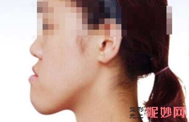 武汉吴中兴截骨怎么样？截骨手术前后效果对比，附较新价格表！