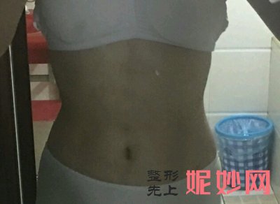 常州美莱抽脂怎么样