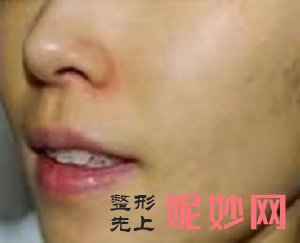 m22光子嫩肤多久做一次，这篇文章告诉你答案