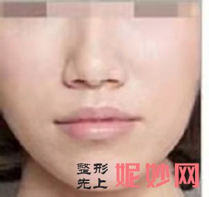 m22光子嫩肤多久做一次，这篇文章告诉你答案