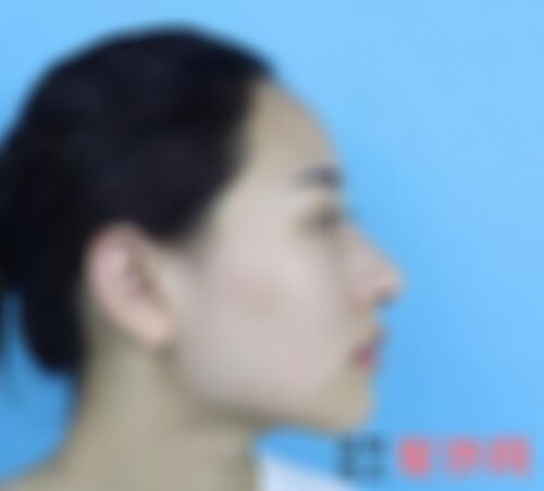 广州曙光整形医院削骨多少钱