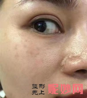 黄金微针真的能缩小毛孔吗，手术效果理想吗