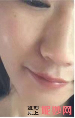 黄金微针真的能缩小毛孔吗，手术效果理想吗