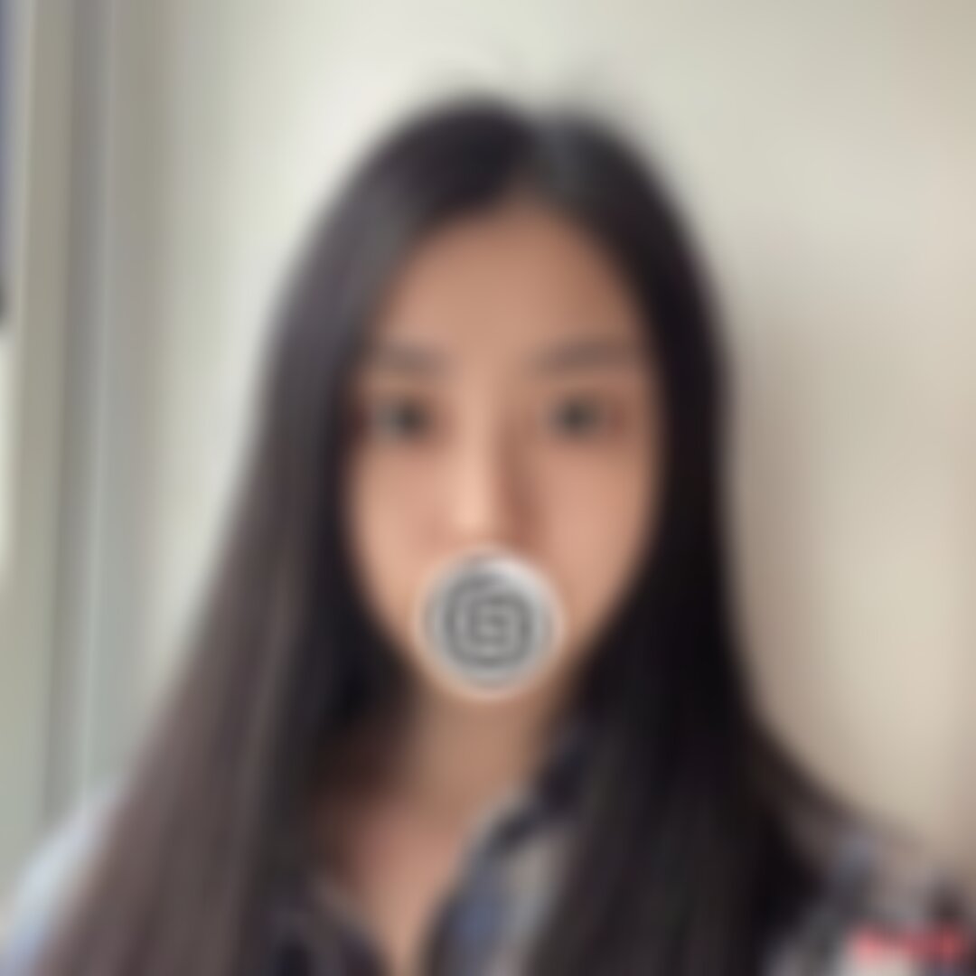 武汉协和整形医院双眼皮案例