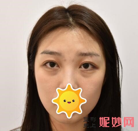 常州美莱去眼袋怎么样