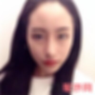 沈阳杏林整形截骨案例