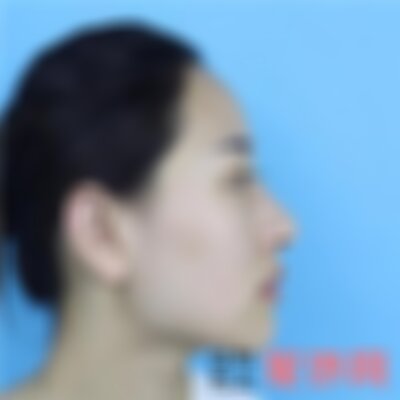 沈阳杏林整形截骨案例