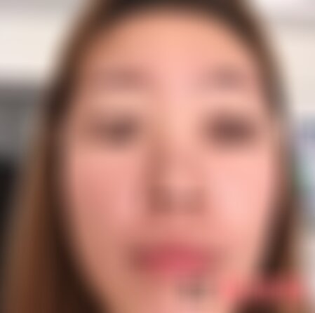 北医三院鼻整形案例怎么样