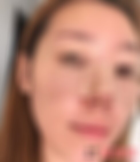 北医三院鼻整形案例怎么样
