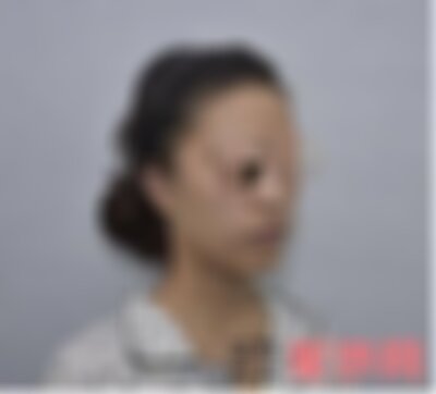 北京韩啸自体脂肪填充怎么样