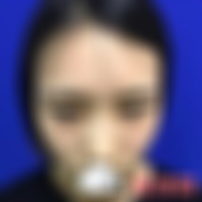 沈阳杏林整形医院做双眼皮的案例