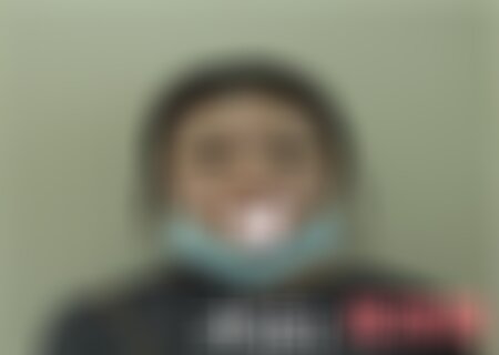 重庆西南整形医院双眼皮案例