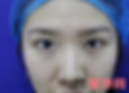 西京整形医院修复眼袋怎么样