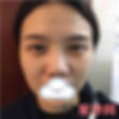 保定华美自体脂肪填充怎么样