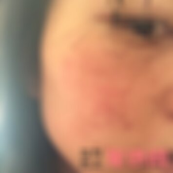 在保定华美祛除红血丝效果如何