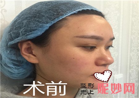 重庆西南整形医院隆鼻案例