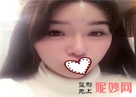 重庆西南整形医院隆鼻案例