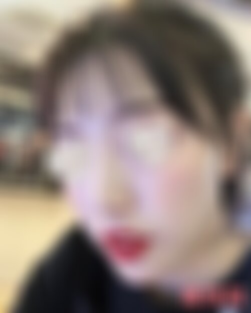 北医三院整形外科假体下巴