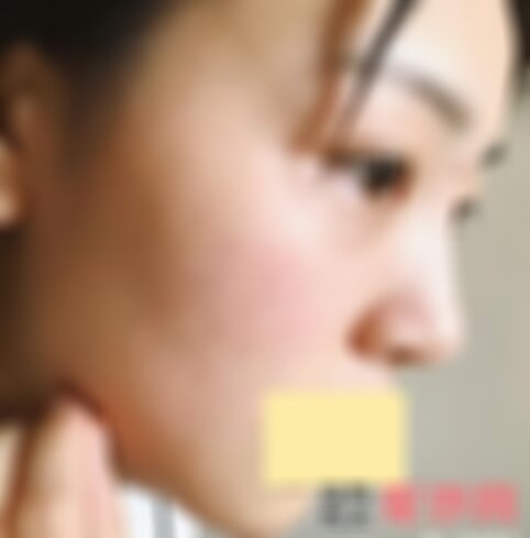 北医三院整形外科假体下巴