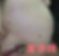 四川华美紫馨去痣怎么样