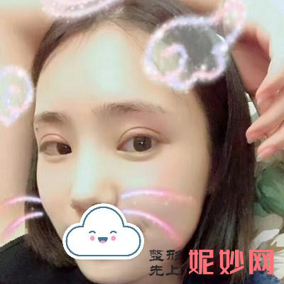 北京润美玉之光做双眼皮怎么样