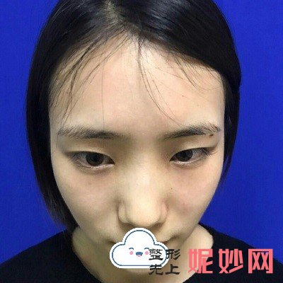 北京润美玉之光做双眼皮怎么样