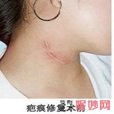 广州曙光医院做疤痕增生好吗