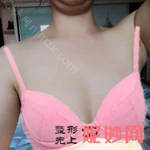 北京新星靓医疗美容医院侯泽民做乳房下垂矫正怎么样?|术后135天效果分享
