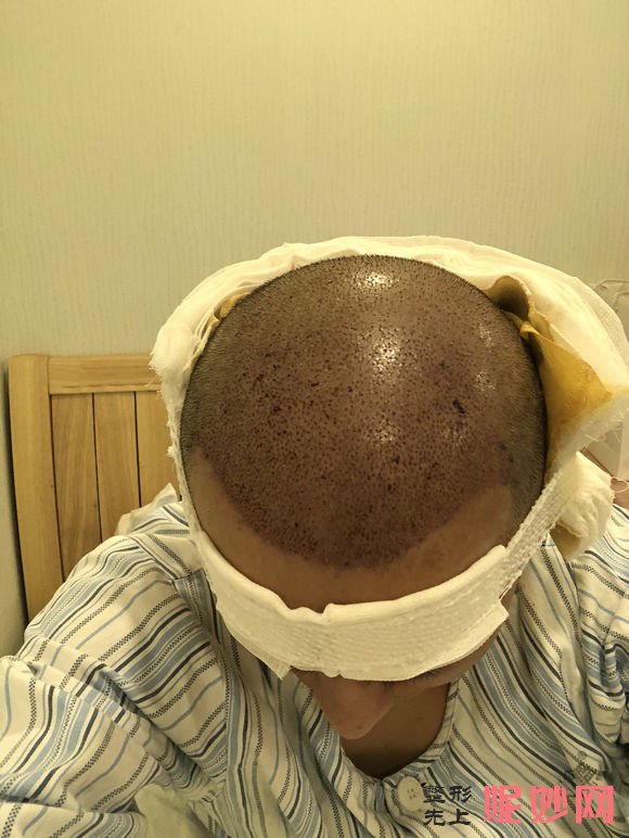 三亚维多利亚医疗美容医院简介,附上秃顶种植收费表及案例