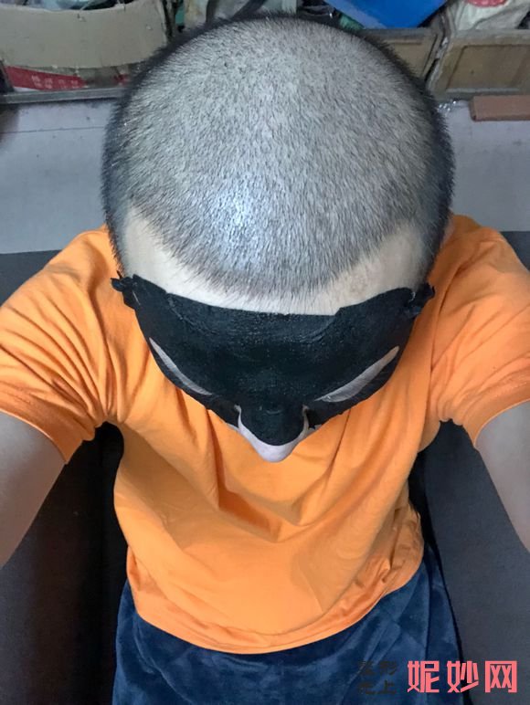 三亚维多利亚医疗美容医院简介,附上秃顶种植收费表及案例