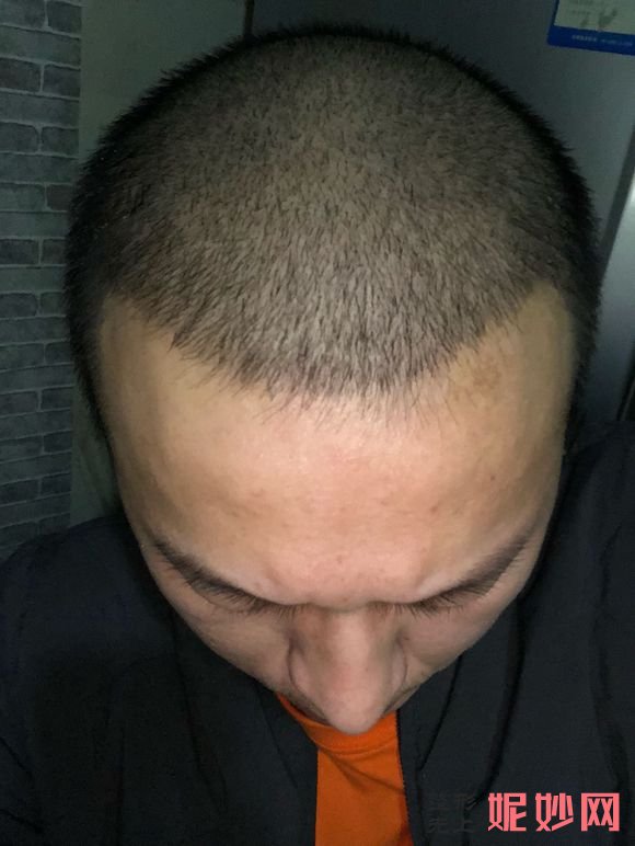 三亚维多利亚医疗美容医院简介,附上秃顶种植收费表及案例