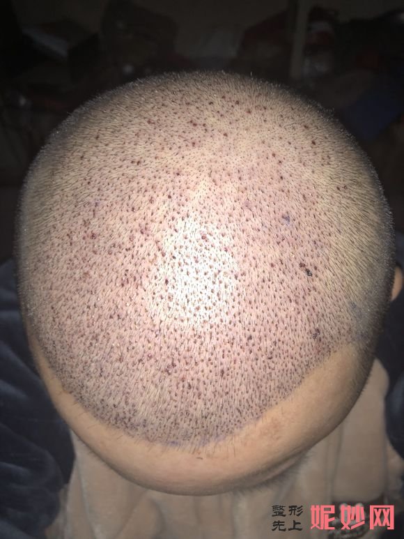 三亚维多利亚医疗美容医院简介,附上秃顶种植收费表及案例