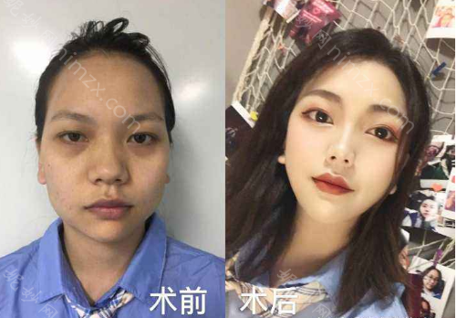 吴中兴下颌角手术怎么样?吴中兴正颌效果及手术案例分享