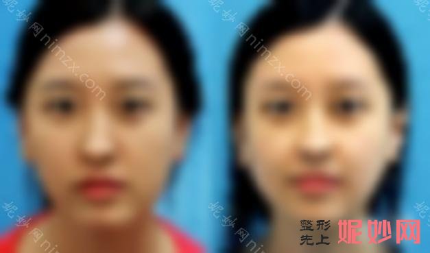 硅胶歪鼻修复可靠吗