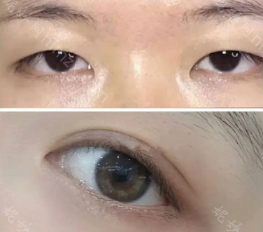 成都的朋友想了解的省医院傅荣做双眼皮怎么样，今天就带案例来了