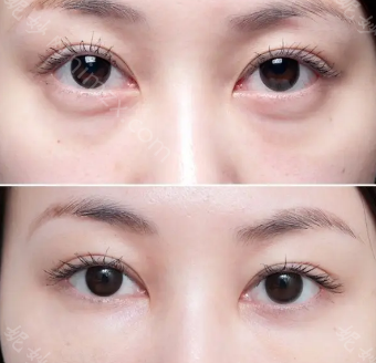 薛红宇做眼袋拿手吗?有做过眼袋的朋友给看看术后对比图吗?
