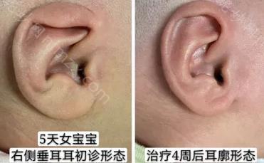 耳朵畸形国家有免费治疗吗？耳畸形手术补助哪些人可以领？