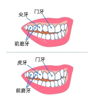 虎牙需不需要做矫正呢？牙齿矫正的方法有哪些