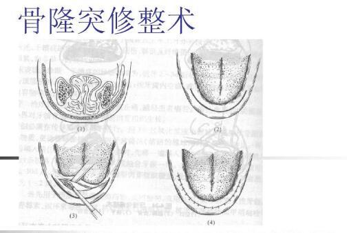 牙槽骨突出整形术是什么?详细说说这项修复手术的过程和费用