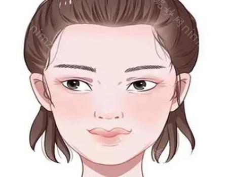 协和白明手术失败怎么样?双眼皮案例分享,技术分析