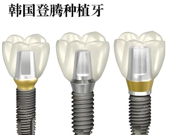 登腾种植牙真相解析：性价比之选的优缺点及使用寿命全揭秘