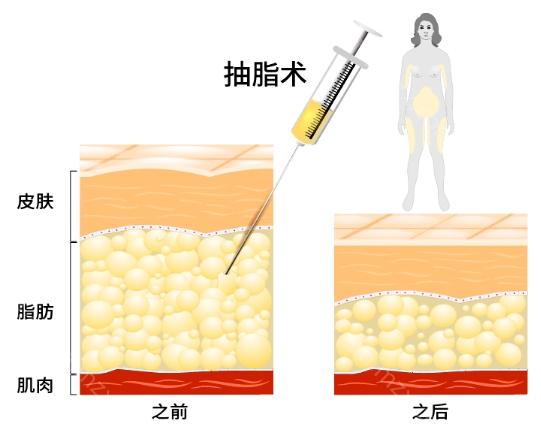 北京纯脂医院正规吗?正规，跟大家说说纯脂为什么改名了