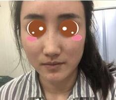 上海九院余庆雄面部吸脂做得怎么样?九院余庆雄面吸案例效果图及价格