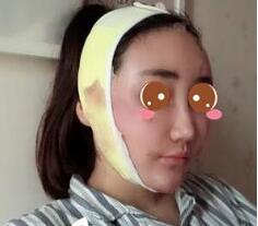 上海九院余庆雄面部吸脂做得怎么样?九院余庆雄面吸案例效果图及价格