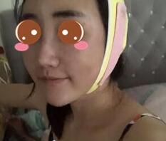 上海九院余庆雄面部吸脂做得怎么样?九院余庆雄面吸案例效果图及价格