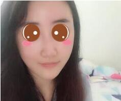 上海九院余庆雄面部吸脂做得怎么样?九院余庆雄面吸案例效果图及价格