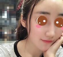 上海九院余庆雄面部吸脂做得怎么样?九院余庆雄面吸案例效果图及价格
