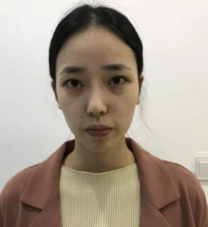 上海九院李圣利整形技术怎么样?李圣利隆鼻案例_预约方式_手术价格