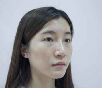 北京八大处焦虎脂肪填充怎么样?八大处焦虎整形技术_案例效果_出诊时间